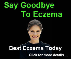 how to treat eczema